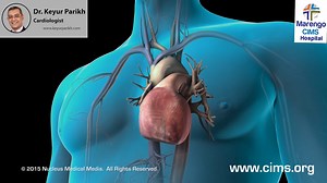 11 reactions | A heart with abnormal signals and atrial fibrillation is shown forming a blood clot which results in a stroke. The steps of the cardioversion procedure, done to restore the normal electrical signals within the heart, are shown. If you like the video please SHARE with friends and family. www.keyurparikh.com #cardioversion #cardiachealth #MarengoCIMS #ahmedabad #keyurparikh | Keyur Parikh | Facebook