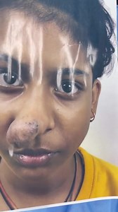 Nasal Hemangioma Resection and Reconstructive Surgery @ Richardsons #hemangioma #tumor #craniofacial #nosejob #reconstructivesurgery #plasticsurgery #plasticsurgeon #majorsurgery #nosesurgery #ent #facesurgeon #craniofacial | Richardsons Dental & Craniofacial Hospital