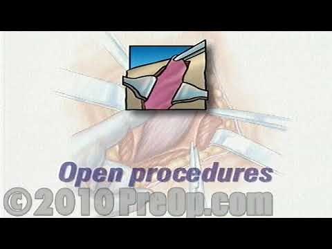 Arthroscopic Meniscus Repair of Knee PreOp® Patient Education Feature