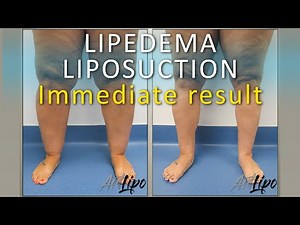 Lipedema Leg Surgery Results | Lipo 360° Legs | Cankles & Knees | ArtLipo | Expert Dr. Thomas Su