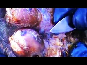 Jigger Removal! Thick and Crusty, Difficult Treatment