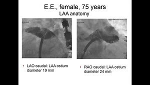 Left Atrial Appendage (LAA) Closure: Why Complications Happen and How to Manage Them