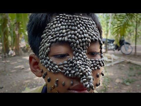 Sad boy with full ticks on his face #074