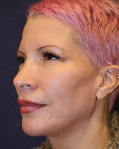 #DiamondInstaFacial & #DiamondFacialSculpting to the jawline. #BeforeAndAfter | Dr. Jason Diamond | Facebook