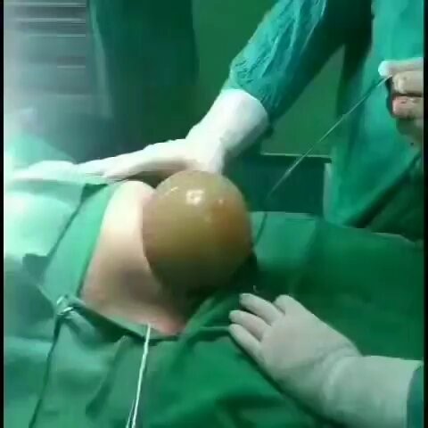 Unassisted C-Section: Baby Delivered En Caul 😮