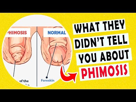 #1 PHIMOSIS: Foreskin too tight to pull back... why and how can i treat it?
