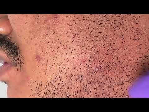Satisfying Beard Ingrown Hair Removal + Extractions on client