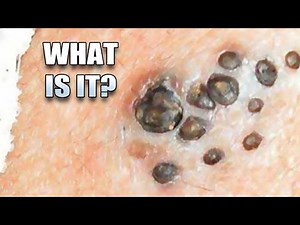 Blackhead Fields, Comedo Naevus