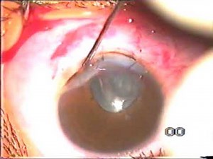 Limbal laceration repair