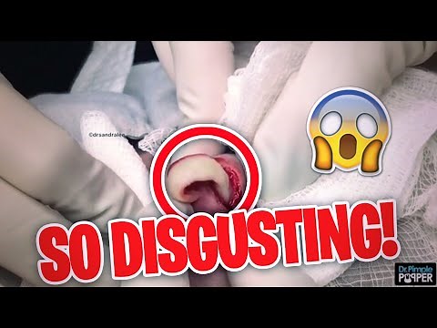 The MOST DISGUSTING Pimple Popping Moments of 2020 (PART 3)