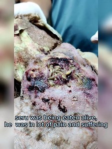 Dog fight and maggot wound . Seru was a community dog from Swyambhu, one day he was attacked by another community dog. He was wounded and was hiding. He didn’t get any help in time because of which his wound got infected. The infected wound attracts flies which lay eggs and later these eggs develop into flesh eating maggots. Seru was being eaten by thousands of flesh eating maggots. A kind animal loverJabi Shrestha informed us about Seru and our rescue team went to the location and brought Seru 