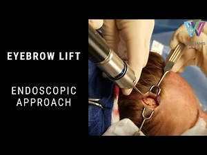 Eyebrow Lift Surgery Using Endoscopic Approach