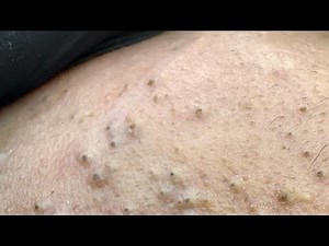 [ASMR] Deep Pore Cleansing and Blackhead Removal Techniques