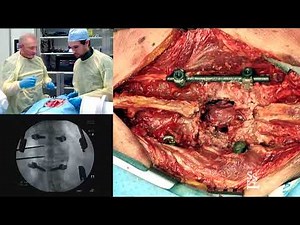 Posterior Decompression of a Burst Fracture - Jens R Chapman, MD