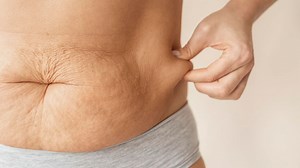 Stretch Marks|Makeup से छुपाएं स्‍ट्रेच मार्क्‍स| Makeup Tips | hide your stretch marks with makeup | Herzindagi