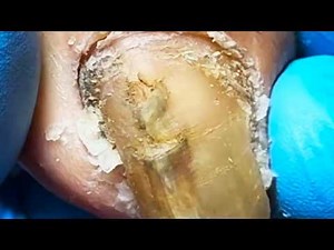 Extra Long Onychomycosis Nails, Hard And Brittle【Podiatry Clinic】