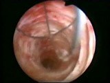 Common Bile Duct Stone Removal - Laparoscopy • Video • MEDtube.net