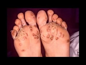 Keratoderma blennorrhagicum