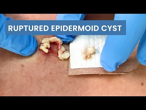 Removing a Ruptured Epidermoid Cyst | CONTOUR DERMATOLOGY