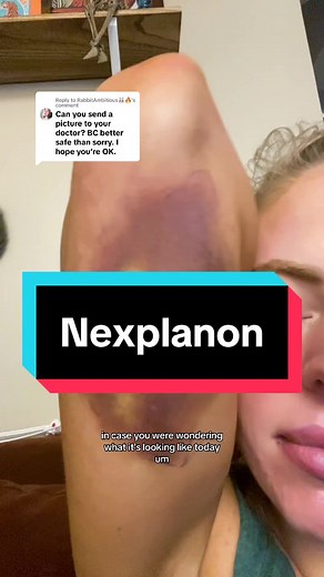 Nexplanon: Implant Experiences, Removal Process, and Side Effects