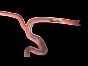 Blood Clot Removal Device