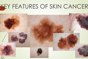 Identification of skin oncological diseases AI