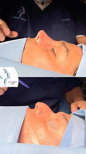 438 reactions · 16 comments | Rinoplastia primaria estructural técnica cerrada ✨ Agenda tu valoración pre operaroria sin costo y esclarece todas tus dudas a cerca de ese procedimiento que siempre has querido ✨ #rinoplastia #otorrinolaringología #cirugiafacialveracruz #rhynoplasty #rhynoplastybeforeandafter #cirugiafacialbocadelrio | Cirugía Facial Veracruz | Facebook