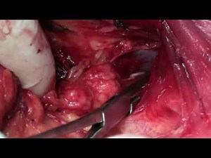 Modified Radical Mastectomy - step by step