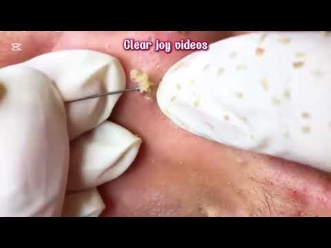 Big Cystic Acne Blackheads Extraction Blackheads & Milia, Whiteheads Removal Pimple Popping