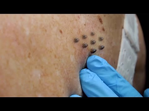 Extreme Blackhead Removal by Hand 2024
