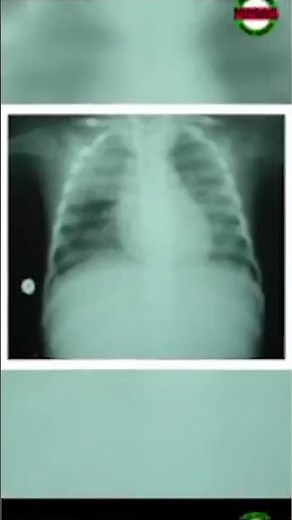 What Is Pulmonary Edema