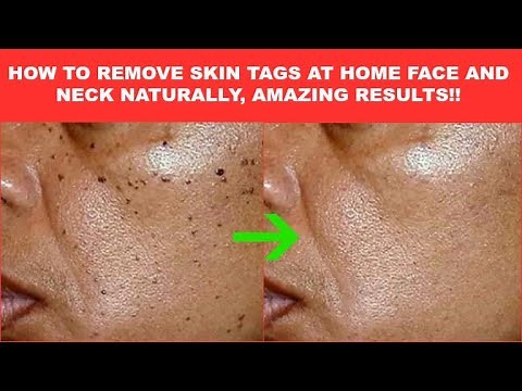SKIN TAGS, LOOK WHAT I USE TO REMOVE SKIN TAGS ON MY FACE AND NECK, HOW TO REMOVE SKIN TAGS FAST