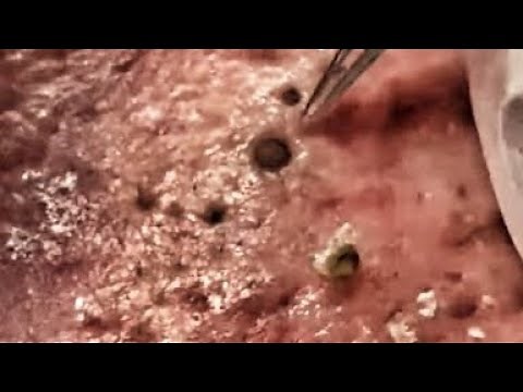 "Extreme Pimple Popping: Unbelievably Gross Extraction!”