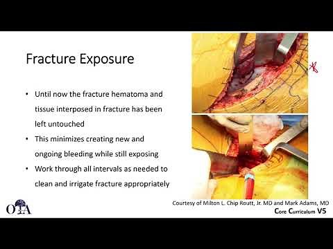 Surgical Approaches to the Acetabulum - Anterior intrapelvic and ilioinguinal 2 of 2 - OTA CCv5
