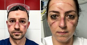 Sjukhuspersonal delar bilder på smärtsamma märken från coronaskydden – bilderna visar deras tuffa vardag