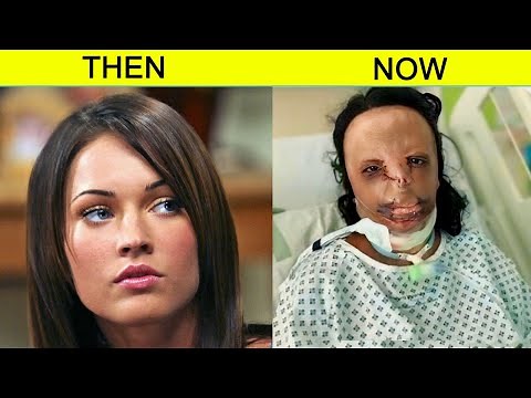 10 Celebrity Plastic Surgery Disasters You’d Never Recognize Today | Then and Now 2025