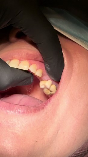 Understanding Teeth Extraction Procedures and Care