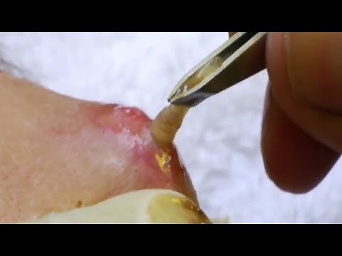 Top 5 Parasite Removals Botfly