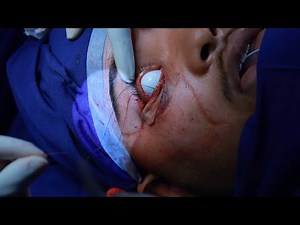 Lower Eyelid Ectropion Surgery | Step-by-Step Surgical Procedure