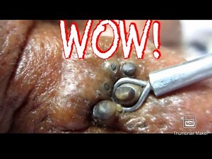 Biggest zits in the world compilation