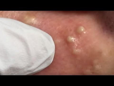 Milia Removal|How to remove milia.