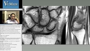 Scapholunate Ligament Injuries: Diagnosis and Management