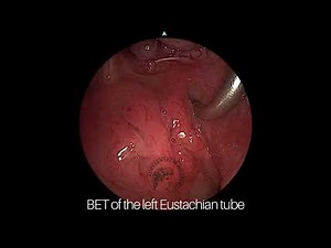 Balloon Dillation of the Eustacian tube surgery
