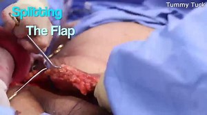 360° Circumferential Lower Body Lift + Thigh Lift after 100lb Weight Loss