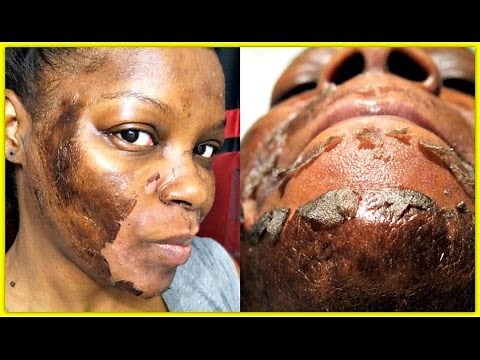 CHEMICAL PEEL EXPERIENCE| 15% & 25% TCA PEEL (GRAPHIC IMAGES)