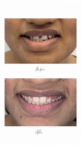 ✨ From Gaps to Gorgeous! Say goodbye to multiple teeth gaps and malaligned teeth and hello to a confident, flawless smile! Our advanced orthodontic treatment aligns your teeth beautifully – pain-free and result-driven. 💯 See the real before and after transformation – because every smile deserves perfection! 🦷 Book your smile makeover today with expert braces treatment near me or inquire about invisible aligners! 📍 Location: UMCC Clinic, Warehouse Road, Bilaspur 📞 Contact: 7503999997 📍 Trust