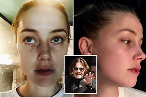 Amber 'suffered bruised ribs, black eyes & broken nose after Depp headbutt'