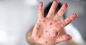 Chăm sóc trẻ bị tay chân miệng tại nhà