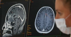 Extended brain fog may be a common symptom after COVID-19 infection, according to study