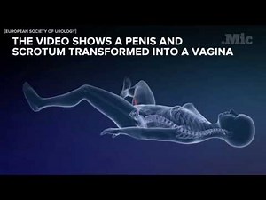 This is what male-to-female sex reassignment surgery looks like